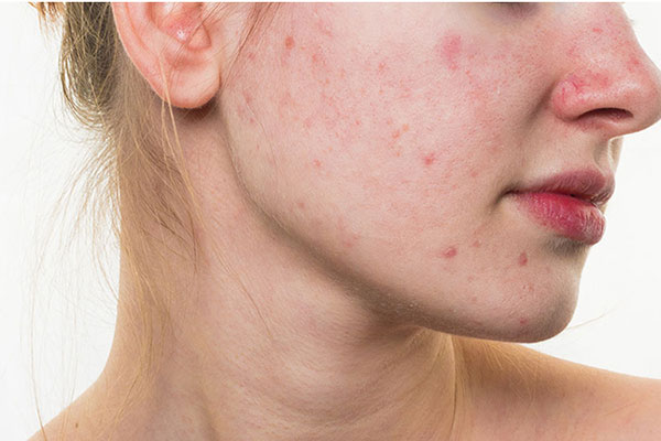 Nội tiết ảnh hưởng thế nào đến làn da và sức khỏe?