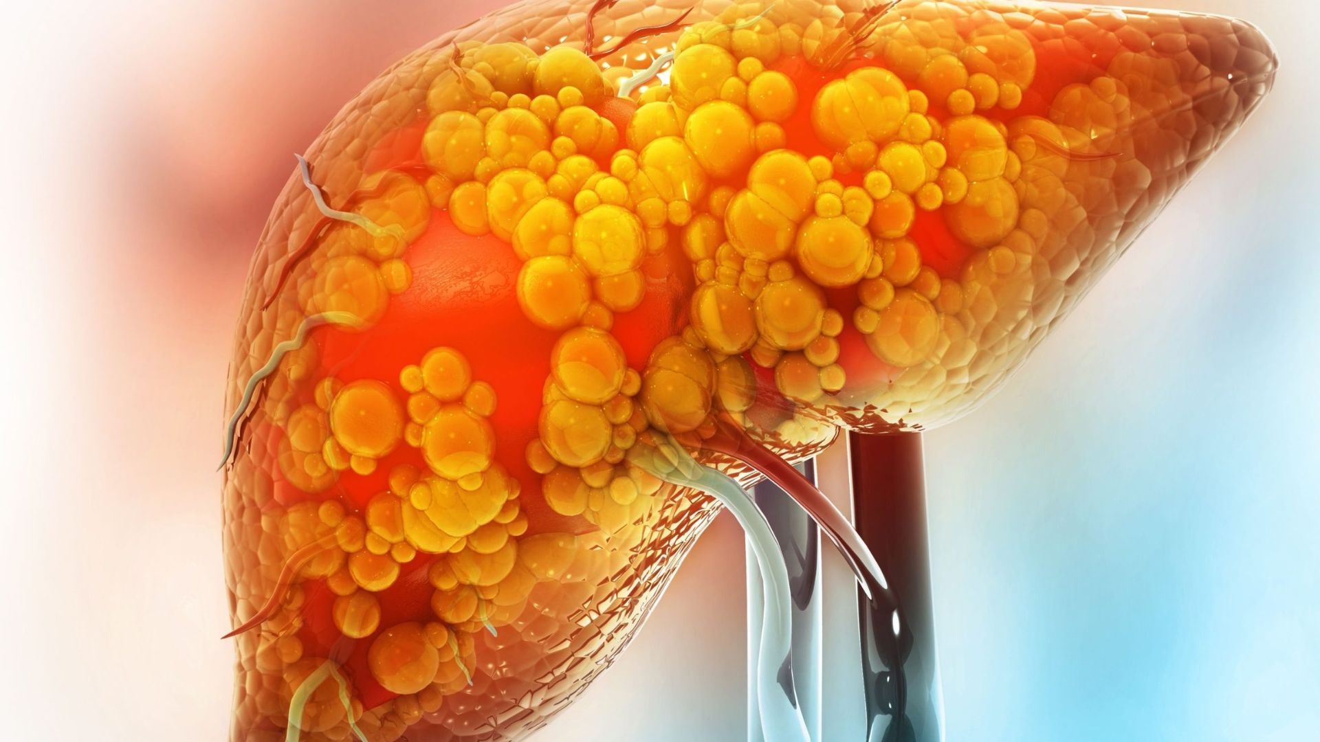 Bác sĩ khuyên gì để hạn chế nguy cơ gan nhiễm mỡ?